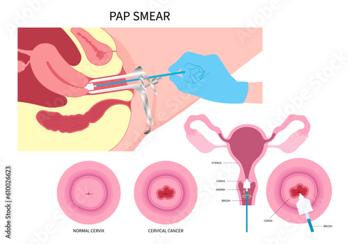 cervix cancer and Examine in women female with obstetric swab vulvar warts prevent by Pap smear test procedure the HPV cervical diagnostic of loop excision sex or LEEP cell cone cytology care screen photo