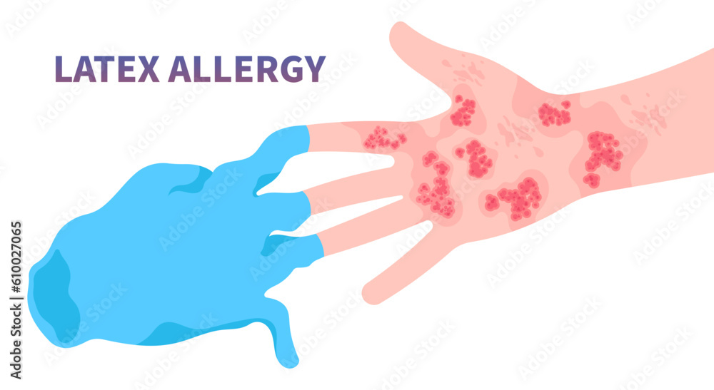 Vetor de latex allergy the allergic itching around finger arm wrist