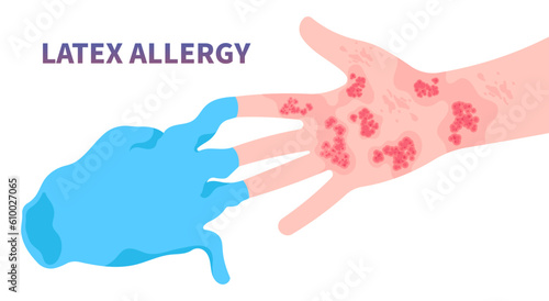 latex allergy the allergic itching around finger arm wrist health care and wear gloves natural pain skin rash and Hives dermatitis with tree dry chemical exposure infection