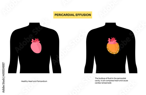 Pericardial effusion heart