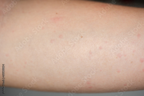 Close-up of whole body urticaria after taking medicine that causes allergies.