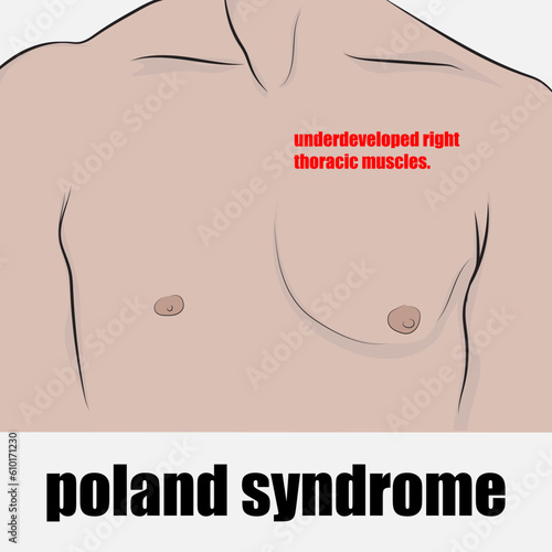 Poland syndrome absence or unilateral underdevelopment of the right pectoralis major muscle in its majority.