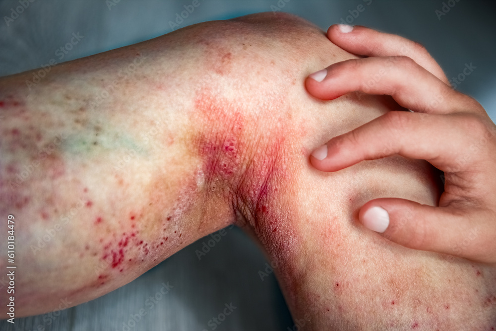 atopic dermatitis on the legs of a child atopic dermatitis on the legs of a child