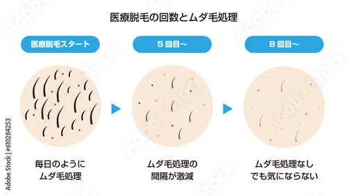医療脱毛の回数とムダ毛処理
