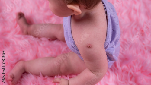 First vaccinations in infants and their marks, infant health, redness in a baby's arm after vaccination