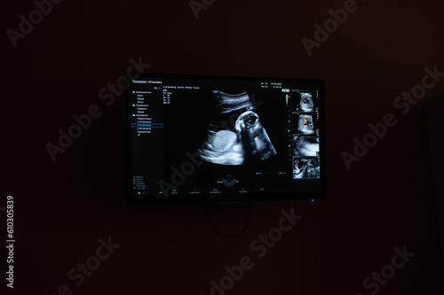 Screen shot of a second trimester prenatal screening. Fototapet