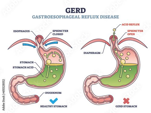 GERD or gastroesophageal reflux disease with digestive acid outline diagram. Labeled educational scheme with medical heartburn feeling cause and compared with healthy process vector illustration.