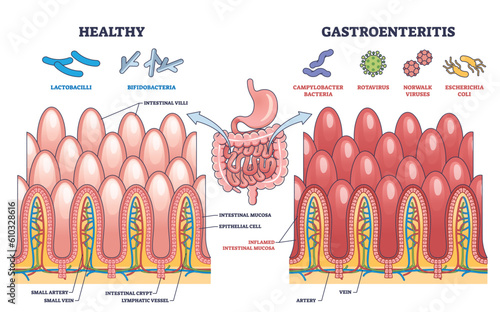 Gastroenteritis or stomach flu microbiological explanation outline diagram. Labeled educational scheme with healthy and bacteria, rotavirus or coli affected intestine comparison vector illustration. photo