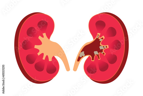 Nephrolithiasis kidney stones disease. cross section of Vector medical illustration. eps 10