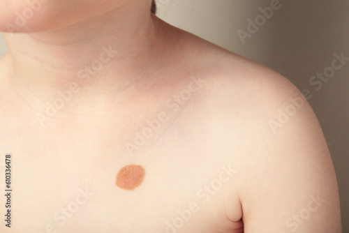 Big mole. Birthmark on body of a child. photo