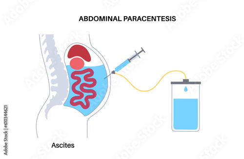 Abdominal paracentesis poster