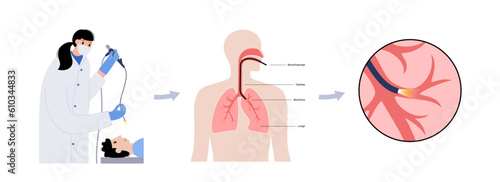 Bronchoscopy procedure concept