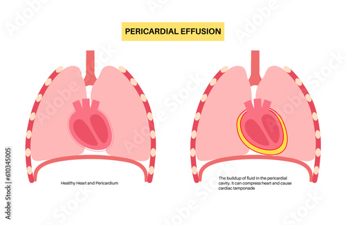 Pericardial effusion heart
