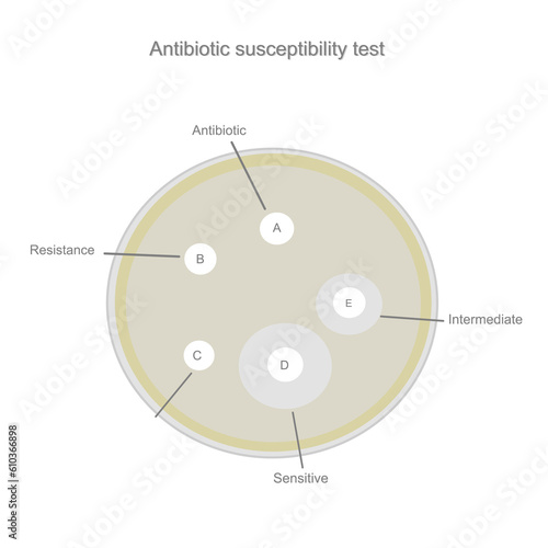 The result of Antibiotic susceptibility test: Resistance, Sensitive and Intermediate Bacteria or fungal that show inhibition zone around antimicrobial drugs pad (A, B, C, D, E).
