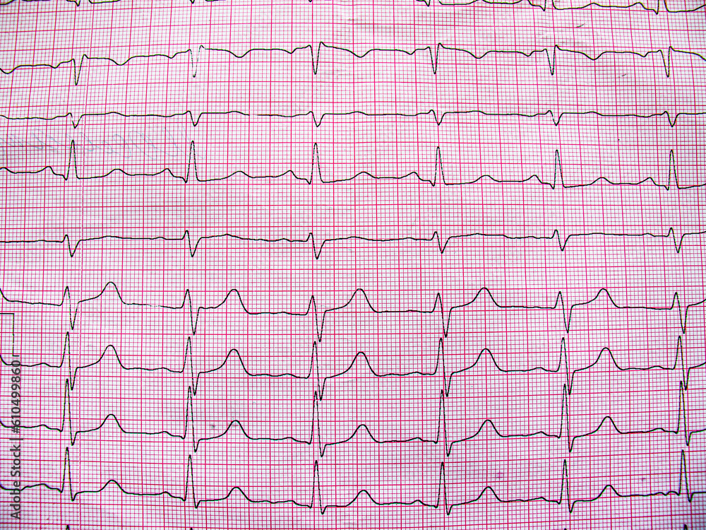 Electrocardiogram example of a normal 12-lead sinus rhythm, close up Electrocardiogram example of a normal 12-lead sinus rhythm, close up