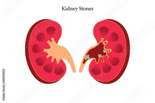 Nephrolithiasis kidney stones disease. cross section of Vector medical illustration. eps 10