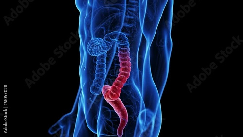 Animation of the colon of a man with colitis ulcerosa photo