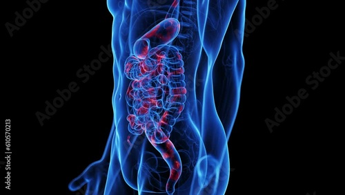 Animation of the colon of a man with Crohn's disease photo