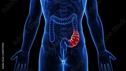 Animation of constipation