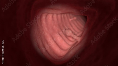 Animation of colon polyps