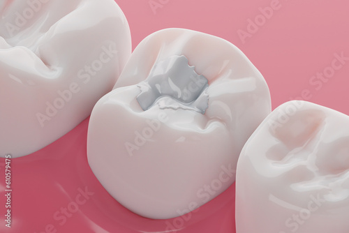 Obraz na plátne Teeth white composite filling, Decay and broken teeth treatment concept