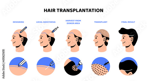 Hair transplantation process infographic. Medical beauty treatments. Fight against alopecia. Design, anesthesia, harvest from donor area and transplant. Cartoon flat vector illustration