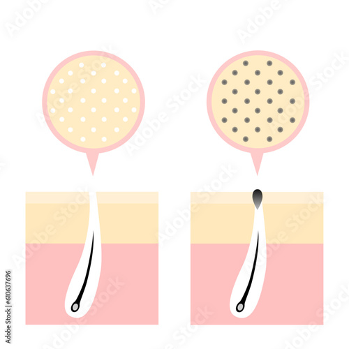 Comparison illustration of normal pores and darkened pores clogged with sebum.
skin care concept.