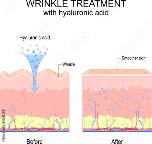 Wrinkle treatment with hyaluronic acid