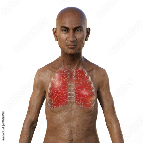 A 3D illustration showcasing the upper half part of an Indian man with transparent skin, revealing the lungs affected by miliary tuberculosis photo