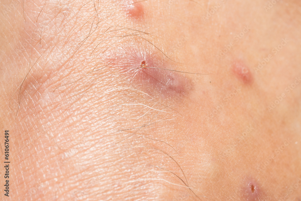 Mosquitos Bites that appear to be slightly infected from scratching Mosquitos Bites that appear to be slightly infected from scratching