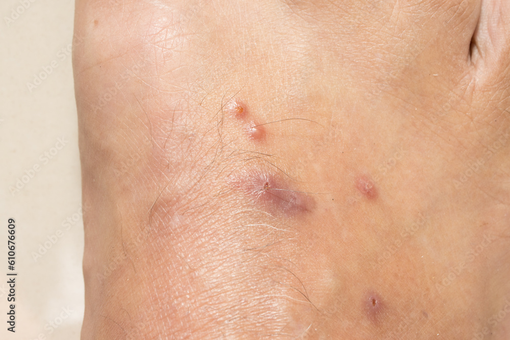 Fototapeta premium Mosquitos Bites that appear to be slightly infected from scratching 