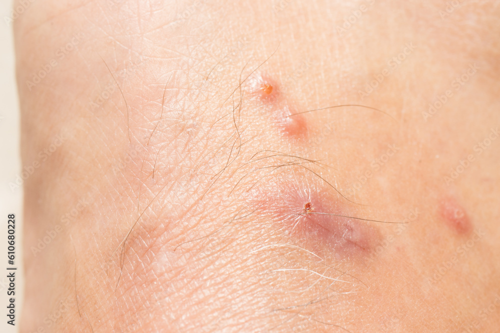 Fototapeta premium Mosquitos Bites that appear to be slightly infected from scratching 