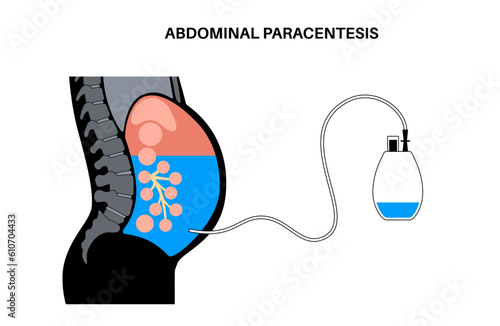 Abdominal paracentesis poster