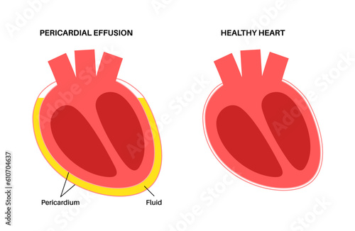 Pericardial effusion heart