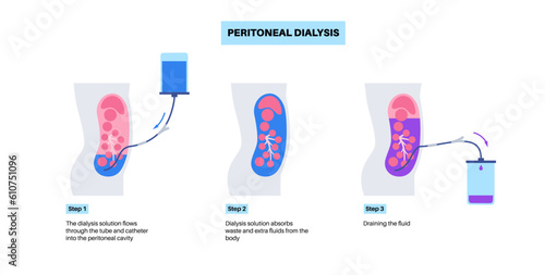 Peritoneal dialysis concept