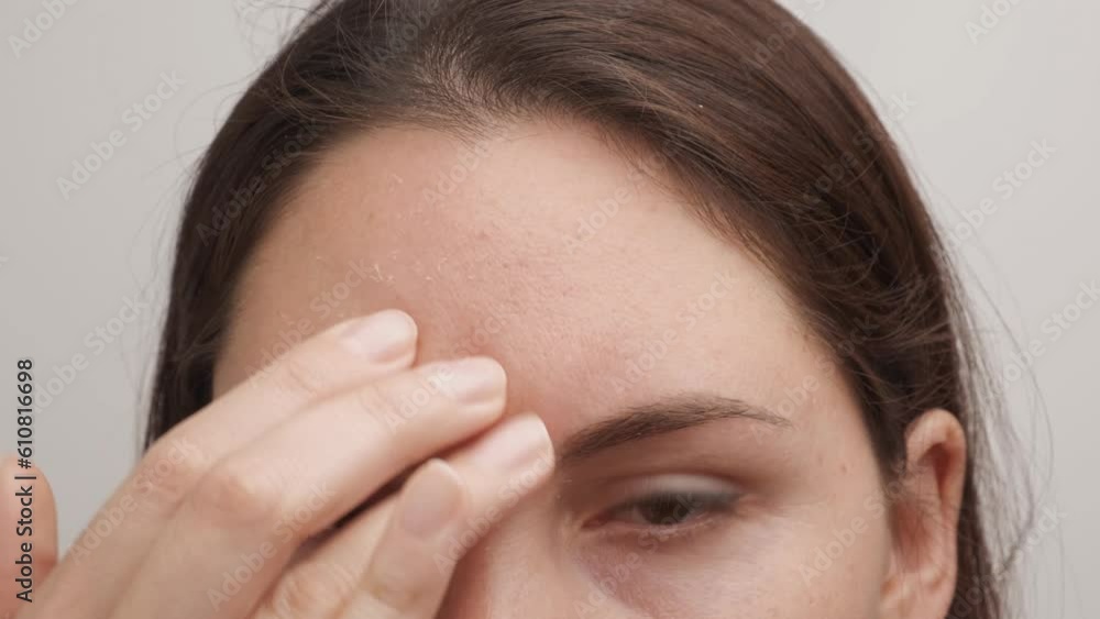 A young attractive woman of Caucasian appearance touches her forehead with one hand. It is very flaky and causes discomfort. Dry dehydrated skin. Looking at the camera A young attractive woman of Caucasian appearance touches her forehead with one hand. It is very flaky and causes discomfort. Dry dehydrated skin. Looking at the camera