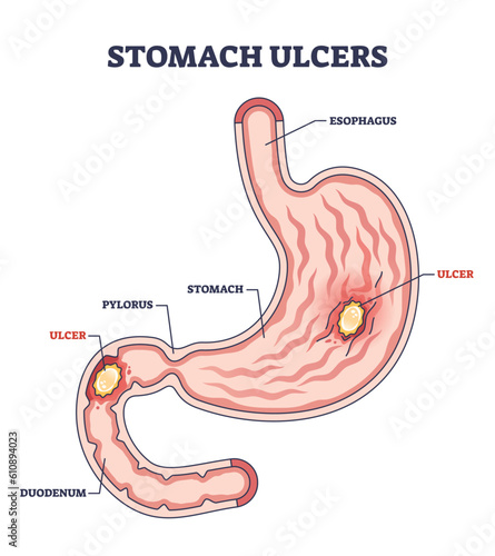 Stomach ulcer as chronic gastric problem with burning pain outline diagram. Labeled educational anatomical digestion scheme with abdomen structure and medical inflammation location vector illustration