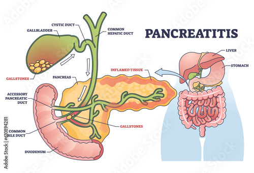 Pancreatitis as pancreas inflammation from chronic or acute gallstones outline diagram. Labeled educational medical scheme with duct anatomy and inflamed digestive tract tissue vector illustration. photo