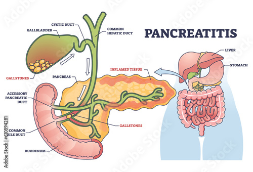 Pancreatitis as pancreas inflammation from chronic or acute gallstones outline diagram. Labeled educational medical scheme with duct anatomy and inflamed digestive tract tissue vector illustration.