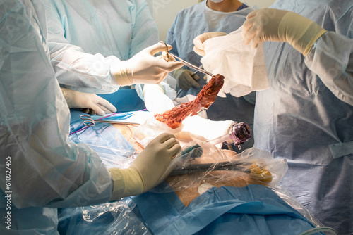 A laparoscopic surgeon at work, performing a minimally invasive surgery, using a robot-assisted, advanced medicine photo