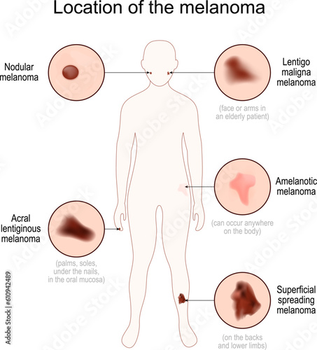 Location of the melanoma. Close-up of malignant skin cancer.