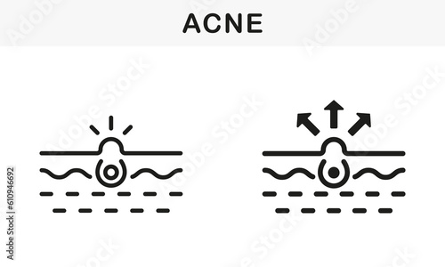 Skin Acne, Blackhead, Comedo Line and Silhouette Black Icon Set. Pimple and Inflammation Sebum Pictogram. Deep Dirty Pore, Skin Problem Symbol Collection. Isolated Vector Illustration
