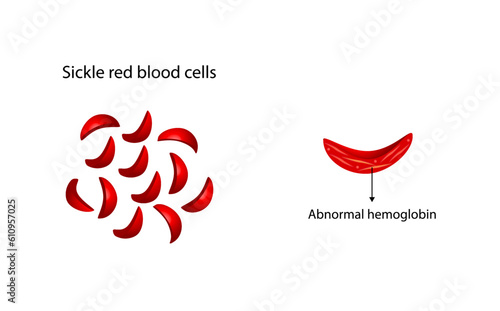  Sickle cell anemia. Sickle red blood cells. Gene mutation. Abnormal hemoglobin, Sickle cell disease. Vector illustration.