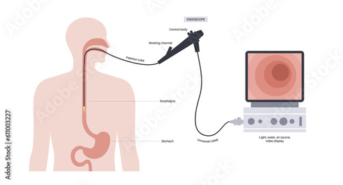 Gastroscopy endoscopy procedure