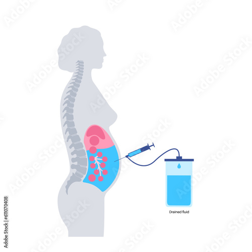 Abdominal paracentesis poster