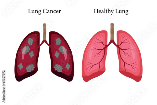 lung cancer and normal lung illustration comparation. bacteria invection. eps 10. icon set photo