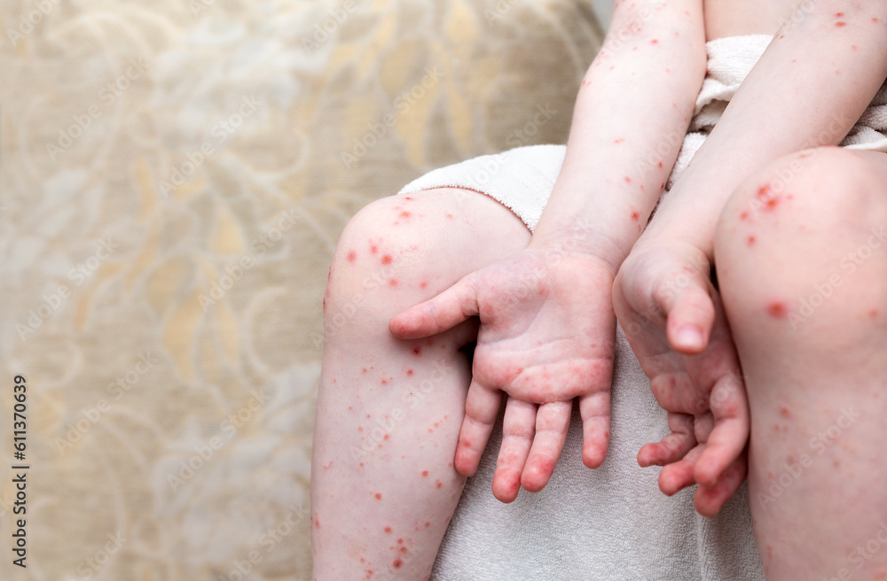 Skin rash on the legs and arms of a young child. Acute viral Coxsackie