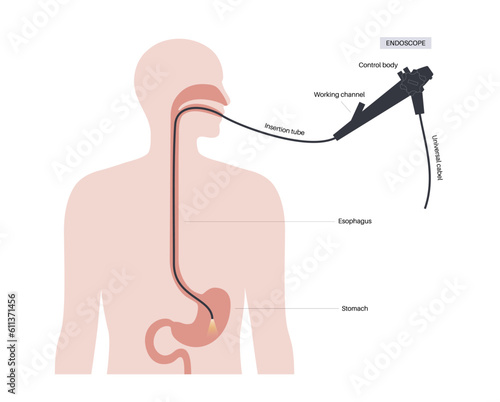 Gastroscopy endoscopy procedure
