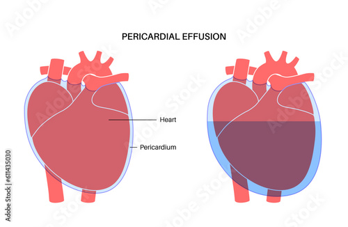 Pericardial effusion heart