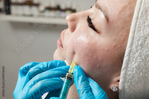 Syringe with a patient's blood plasma in a cosmetologist's hand for a plasmolifting of a woman's facial skin. Plasma therapy, skin cell restoration. photo